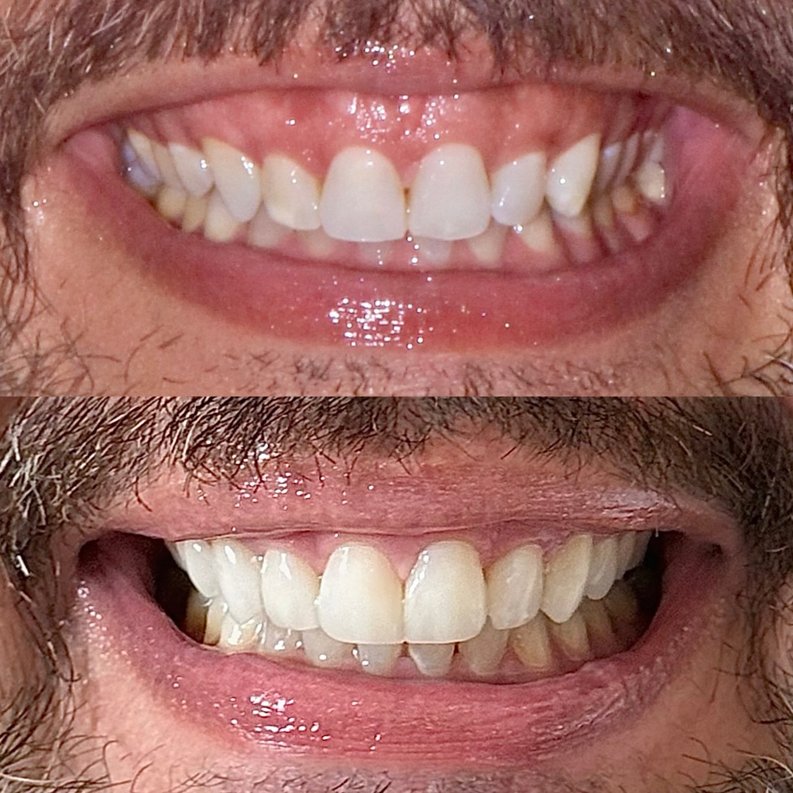 SORRISO ÂNGELO ANTES_DEPOIS